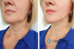 Double chin before and after Hi-Fu treatment 4 Book your double chin treatment Stamford today! We are here to help!