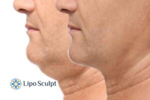 Double chin before and after Hi-Fu treatment 2 Double chin treatment Stamford from Lipo Sculpt - feel more confident today!