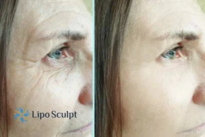 How to Fight Aging Symptoms 2 Do you want to Fight Aging Symptoms Stamford? Contact Lipo Sculpt today!