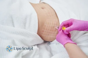 Are The Results From Aqualyx Permanent? 1 Do you want to know how long Aqualyx Stamford results last?