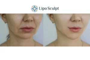 Explaining Total Skin Tightening Treatment And What It Can Do For You 2 Do you want to boost your self confidence? Give Morpheus8 Stamford a try today!