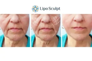 Explaining Total Skin Tightening Treatment And What It Can Do For You 3 Boost your confidence with Morpheus8 Stamford call our team today!