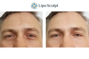 Explaining Total Skin Tightening Treatment And What It Can Do For You 6 Morpheus8 Stamford book in today to find out more!