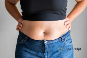 Bidding Farewell to Muffin Tops with Aqualyx Fat Injections 2 Do you wish you could reduce your muffin top Stamford With Aqualy fat dissolving injections you can!