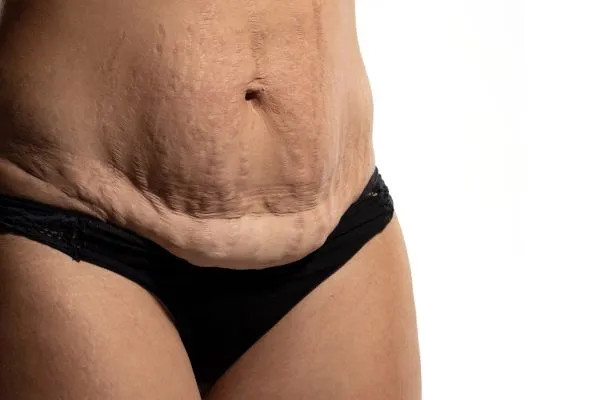 Lost the Weight but Not the Loose Skin? 1 image of womans stomach after weight loss showing loose skin Stamford